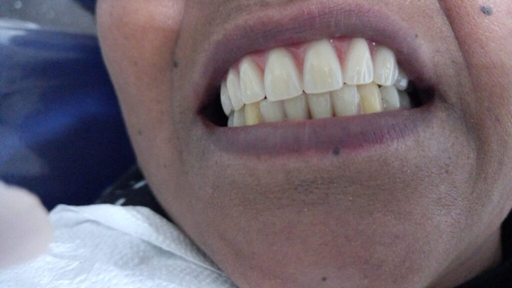 clareamento dental Carapicuíba