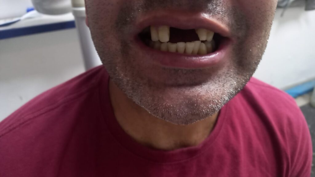 clareamento dental Carapicuíba