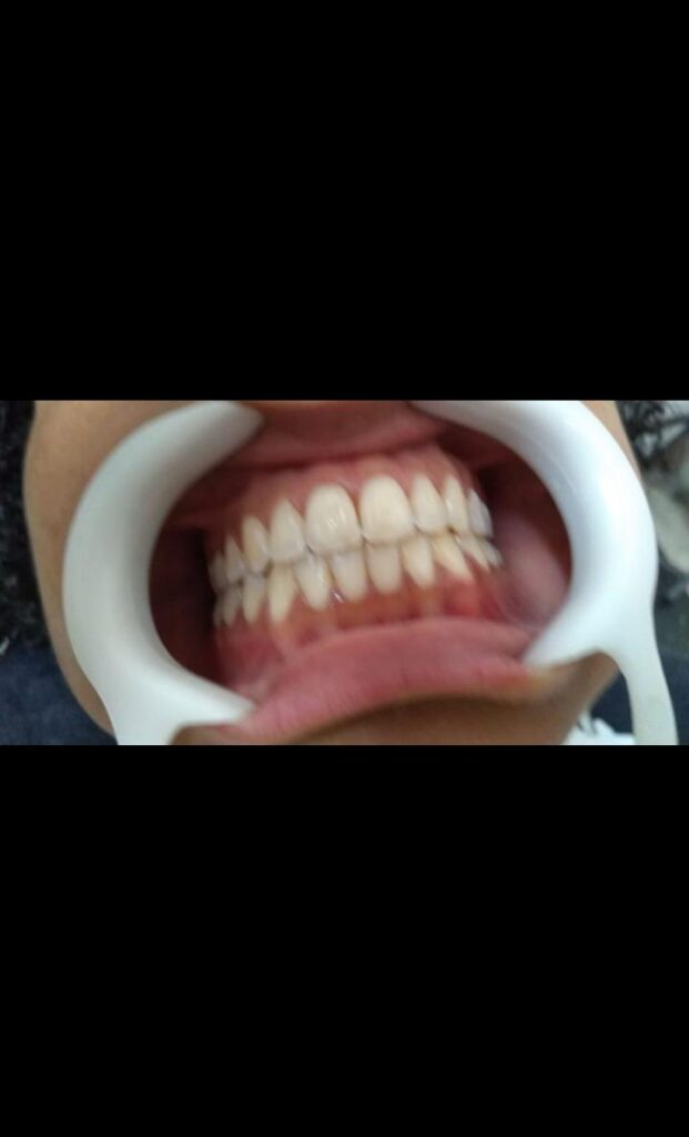 clareamento dental Carapicuíba