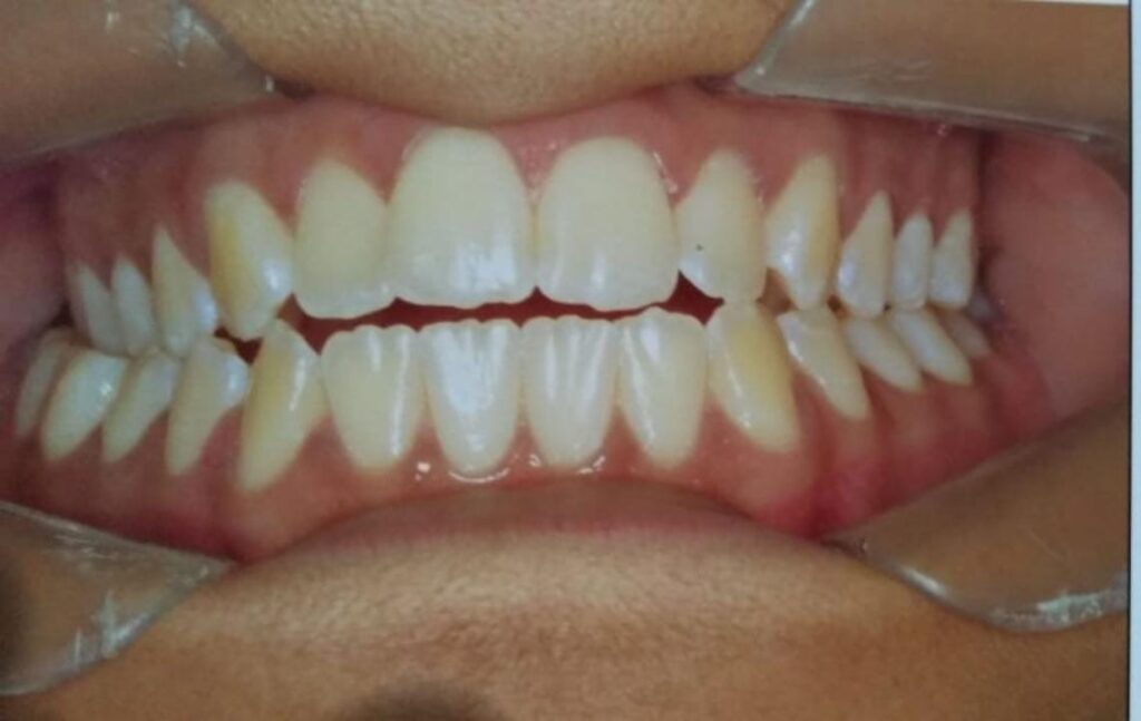 clareamento dental Carapicuíba
